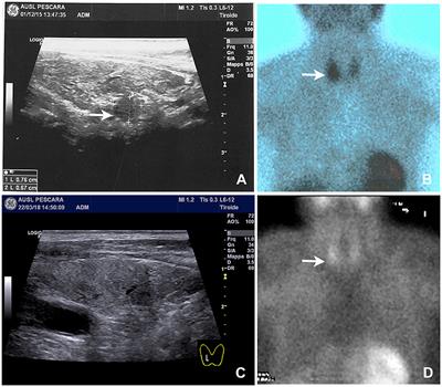 Parathyroid Apoplexy Following Cinacalcet Treatment in Primary Hyperparathyroidism